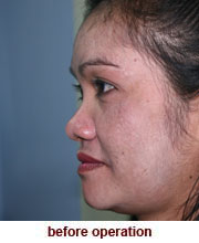 plastic_surgery_augmentation_rhinoplasty